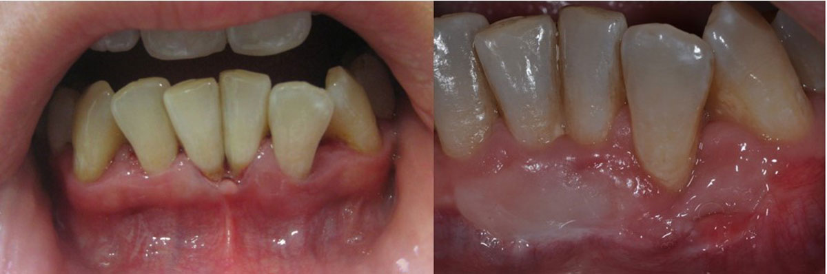 Periodoncia