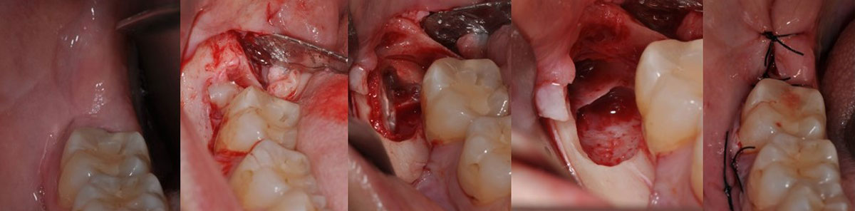 cirugía-bucal-caso-1