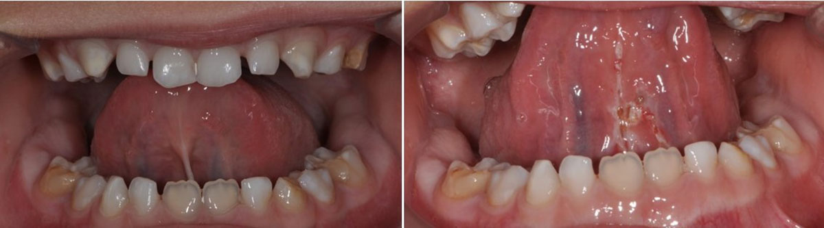 cirugía-bucal-caso